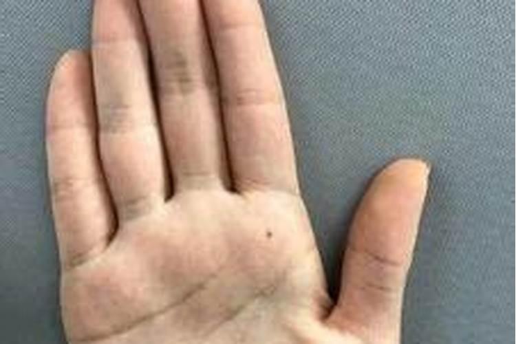 掌心痣天煞孤星命怎么破？