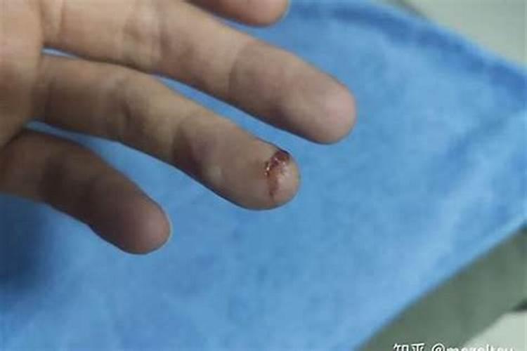 梦见手被割了个很深的伤口