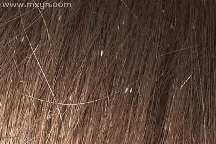 梦见别人头上长虱子是什么意思？