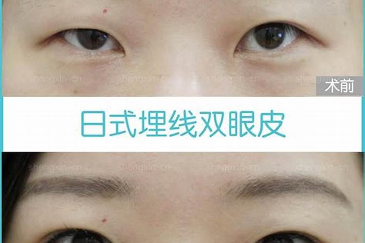 犯太岁可以做双眼皮吗？